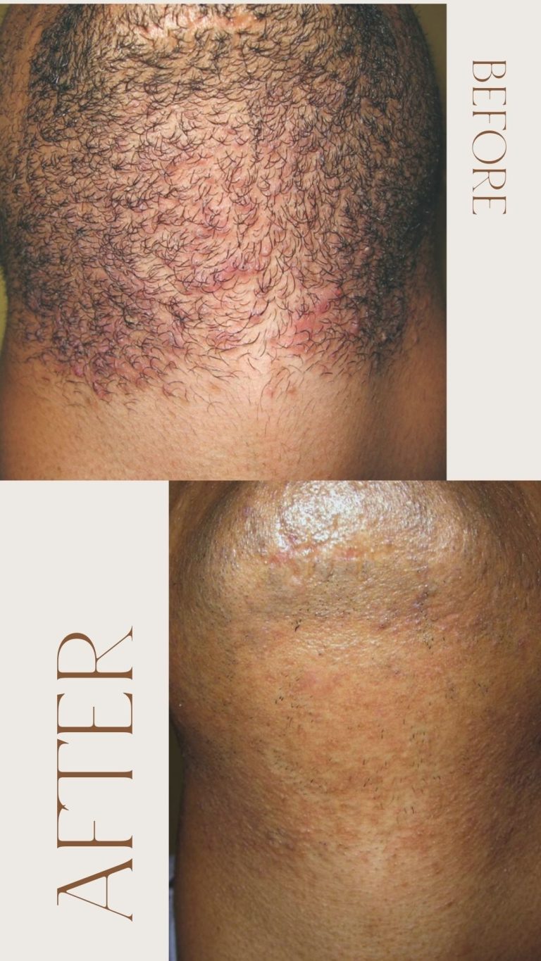 Avant après épilation laser barbe homme Avant après épilation laser barbe homme
