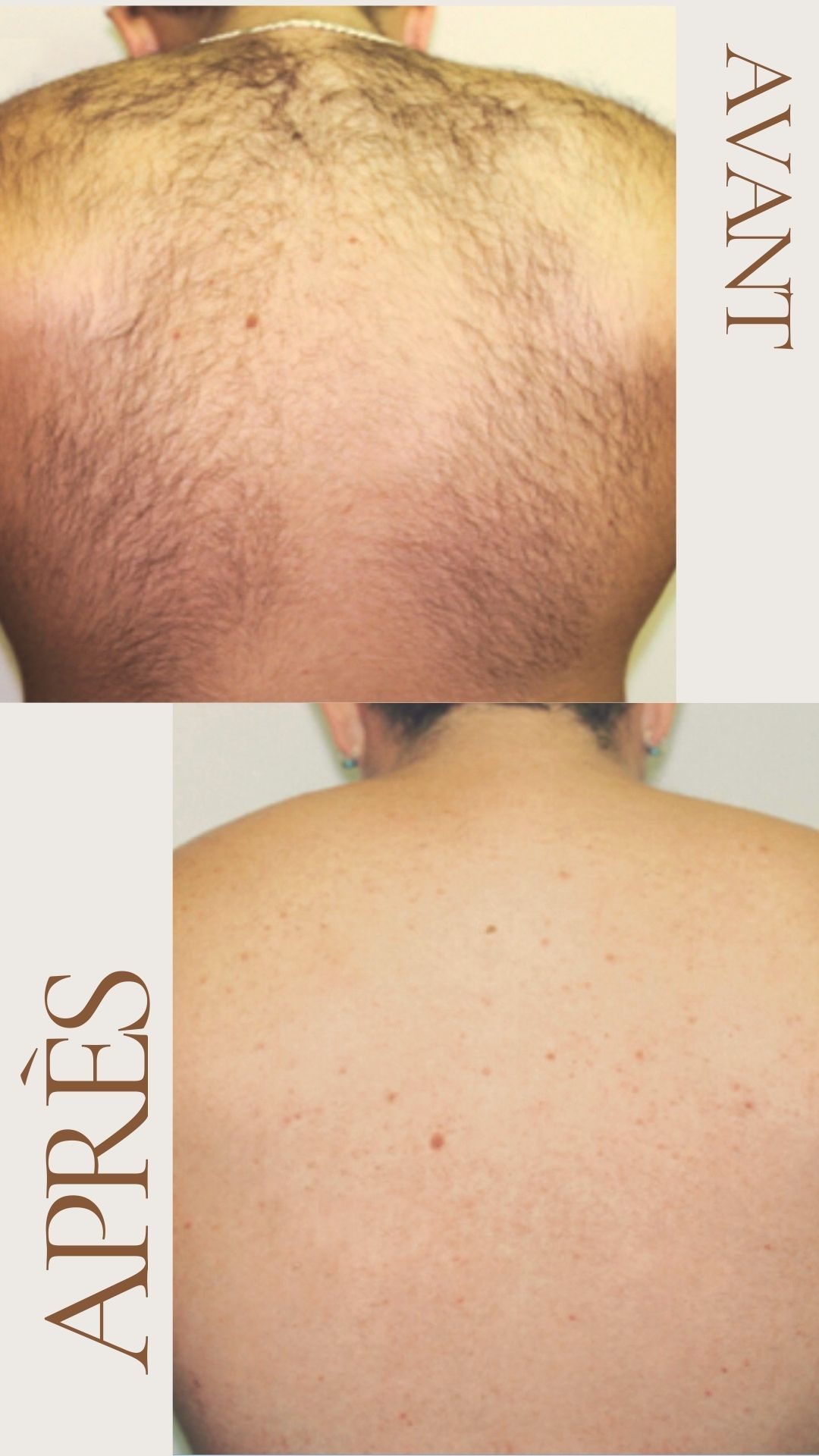 Avant après 5 séances épilation définitive au laser dos homme Avant après épilation laser dos homme