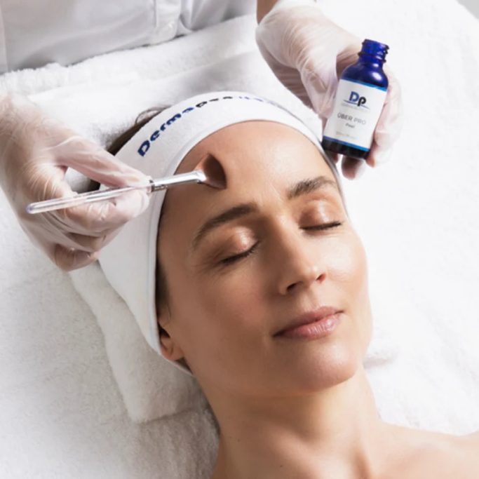 Peeling ciblé imperfections et acné pour une peau plus nette et uniforme. Uber Peel Deemaceuticals Wattrelos peeling acné imperfections