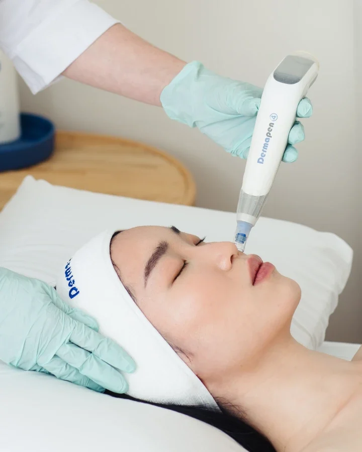Microneedling visage Wattrelos Dermapen 4 qualité de peau